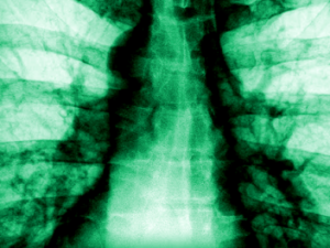 Die 3D-gedruckte Rippe Screenshot youtube.com